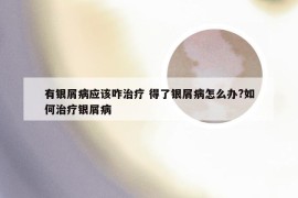 有银屑病应该咋治疗 得了银屑病怎么办?如何治疗银屑病