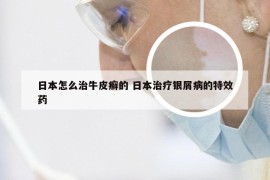日本怎么治牛皮癣的 日本治疗银屑病的特效药