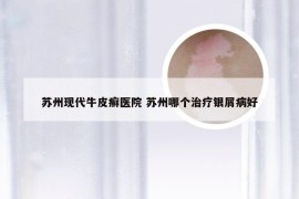 苏州现代牛皮癣医院 苏州哪个治疗银屑病好