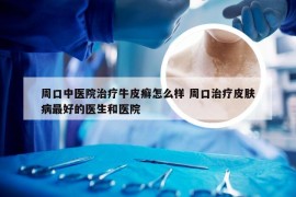周口中医院治疗牛皮癣怎么样 周口治疗皮肤病最好的医生和医院