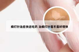 癣打针治愈快还吃药 治癣打针是不是好得快