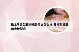 换上寻常型银削病最后会怎么样 寻常型银屑病会转型吗