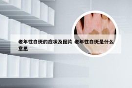 老年性白斑的症状及图片 老年性白斑是什么意思