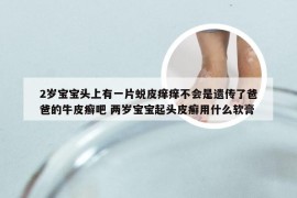 2岁宝宝头上有一片蜕皮痒痒不会是遗传了爸爸的牛皮癣吧 两岁宝宝起头皮癣用什么软膏