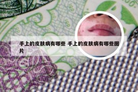 手上的皮肤病有哪些 手上的皮肤病有哪些图片