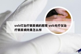 uvb灯治疗银屑病的原理 uvb光疗仪治疗银屑病效果怎么样