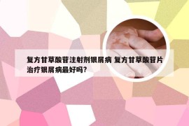 复方甘草酸苷注射剂银屑病 复方甘草酸苷片治疗银屑病最好吗?