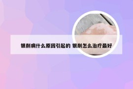 银削病什么原因引起的 银削怎么治疗最好