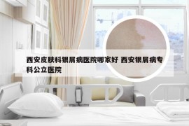 西安皮肤科银屑病医院哪家好 西安银屑病专科公立医院