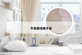 牛皮癣没有干皮