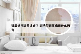 银屑病用斑蝥涂好了 斑块型银屑病用什么药膏