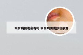 银屑病阴囊会有吗 银屑病阴囊部位病变