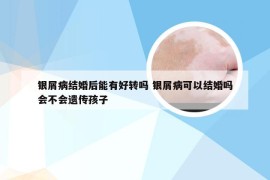 银屑病结婚后能有好转吗 银屑病可以结婚吗会不会遗传孩子