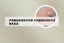 中药癣皮的功效与作用 中药癣皮的功效与作用及禁忌