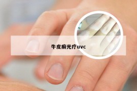 牛皮癣光疗uvc