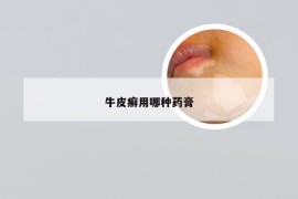 牛皮癣用哪种药膏