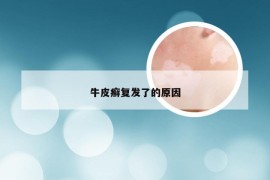 牛皮癣复发了的原因