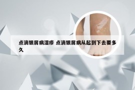 点滴银屑病湿疹 点滴银屑病从起到下去要多久