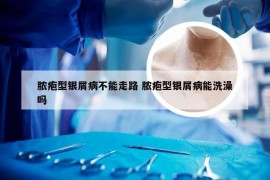 脓疱型银屑病不能走路 脓疱型银屑病能洗澡吗