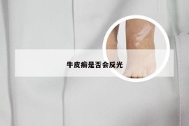 牛皮癣是否会反光