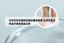 北京空军总医院皮肤科看银屑病 北京空军总院治疗银屑病怎么样