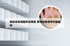 聊城皮肤病医院在哪里 聊城皮肤病专科医医院