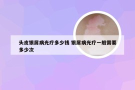 头皮银屑病光疗多少钱 银屑病光疗一般需要多少次