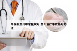 牛皮癣兰州哪家医院好 兰州治疗牛皮最好方法