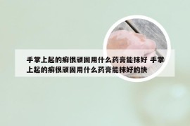 手掌上起的癣很顽固用什么药膏能抹好 手掌上起的癣很顽固用什么药膏能抹好的快