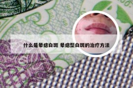 什么是晕痣白斑 晕痣型白斑的治疗方法