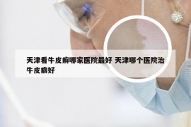 天津看牛皮癣哪家医院最好 天津哪个医院治牛皮癖好
