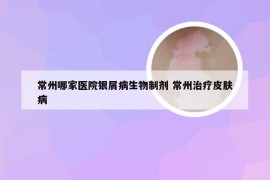 常州哪家医院银屑病生物制剂 常州治疗皮肤病
