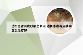 透析患者有皮肤病怎么治 透析患者有皮肤病怎么治疗好