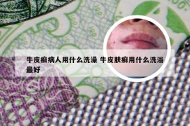 牛皮癣病人用什么洗澡 牛皮肤癣用什么洗浴最好