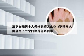 三岁女孩两个大拇指长癣怎么办 3岁孩子大拇指甲上一个凹痕是怎么回事