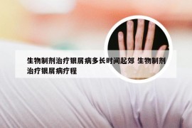 生物制剂治疗银屑病多长时间起郊 生物制剂治疗银屑病疗程