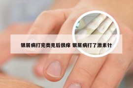 银屑病打完类克后很痒 银屑病打了激素针
