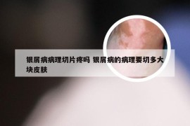 银屑病病理切片疼吗 银屑病的病理要切多大块皮肤