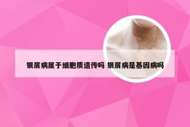 银屑病属于细胞质遗传吗 银屑病是基因病吗