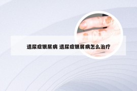 遗尿症银屑病 遗尿症银屑病怎么治疗