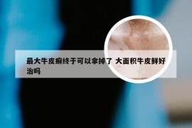 最大牛皮癣终于可以拿掉了 大面积牛皮鲜好治吗