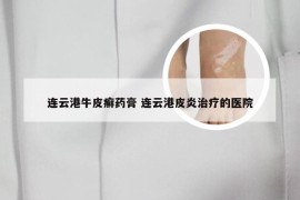 连云港牛皮癣药膏 连云港皮炎治疗的医院