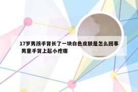 17岁男孩手背长了一块白色皮肤是怎么回事 男童手背上起小疙瘩