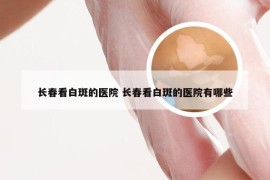 长春看白斑的医院 长春看白斑的医院有哪些