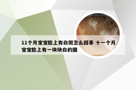 11个月宝宝脸上有白斑怎么回事 十一个月宝宝脸上有一块块白的图