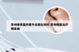 常州哪家医院看牛皮癣比较好 常州哪里治疗银屑病