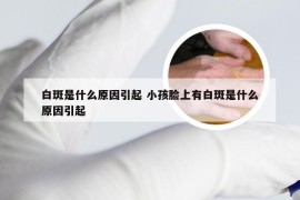 白斑是什么原因引起 小孩脸上有白斑是什么原因引起