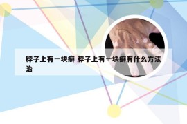 脖子上有一块癣 脖子上有一块癣有什么方法治