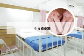 牛皮癣变薄