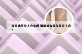 银屑病屁股上会有吗 银屑病会长在屁股上吗?
